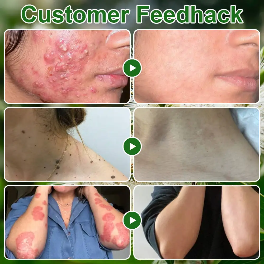 ๐๐๐ ๐๐ซ๐๐ ๐๐ข๐ฅ ๐๐ค๐ข๐ง ๐๐ซ๐๐๐ญ๐ฆ๐๐ง๐ญ ๐๐ซ๐๐๐ฆ - Image 3