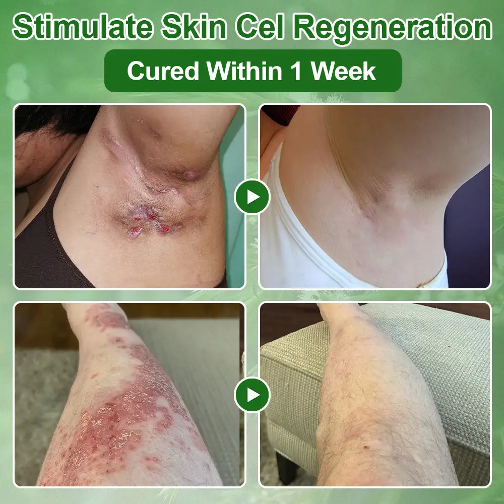 ๐๐๐ ๐๐ซ๐๐ ๐๐ข๐ฅ ๐๐ค๐ข๐ง ๐๐ซ๐๐๐ญ๐ฆ๐๐ง๐ญ ๐๐ซ๐๐๐ฆ - Image 6