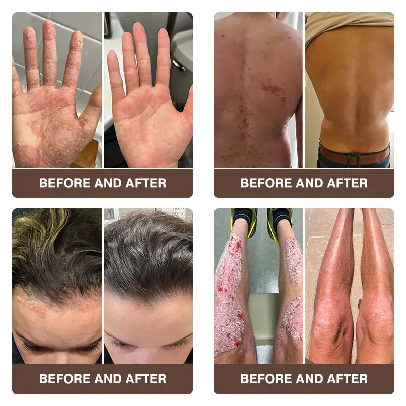 ๐๐ฎ๐ฅ๐ญ๐ข-๐๐ฒ๐ฆ๐ฉ๐ญ๐จ๐ฆ ๐๐ฌ๐จ๐ซ๐ข๐๐ฌ๐ข๐ฌ & ๐๐๐ณ๐๐ฆ๐ ๐๐ซ๐๐๐ญ๐ฆ๐๐ง๐ญ ๐๐ซ๐๐๐ฆ - Image 4