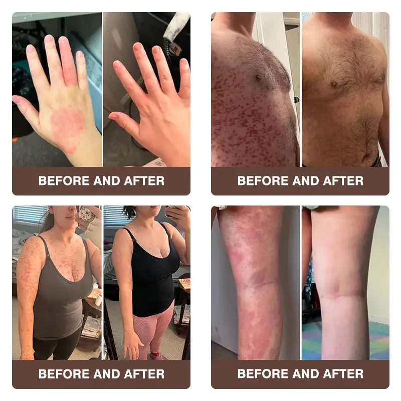 ๐๐ฎ๐ฅ๐ญ๐ข-๐๐ฒ๐ฆ๐ฉ๐ญ๐จ๐ฆ ๐๐ฌ๐จ๐ซ๐ข๐๐ฌ๐ข๐ฌ & ๐๐๐ณ๐๐ฆ๐ ๐๐ซ๐๐๐ญ๐ฆ๐๐ง๐ญ ๐๐ซ๐๐๐ฆ - Image 5