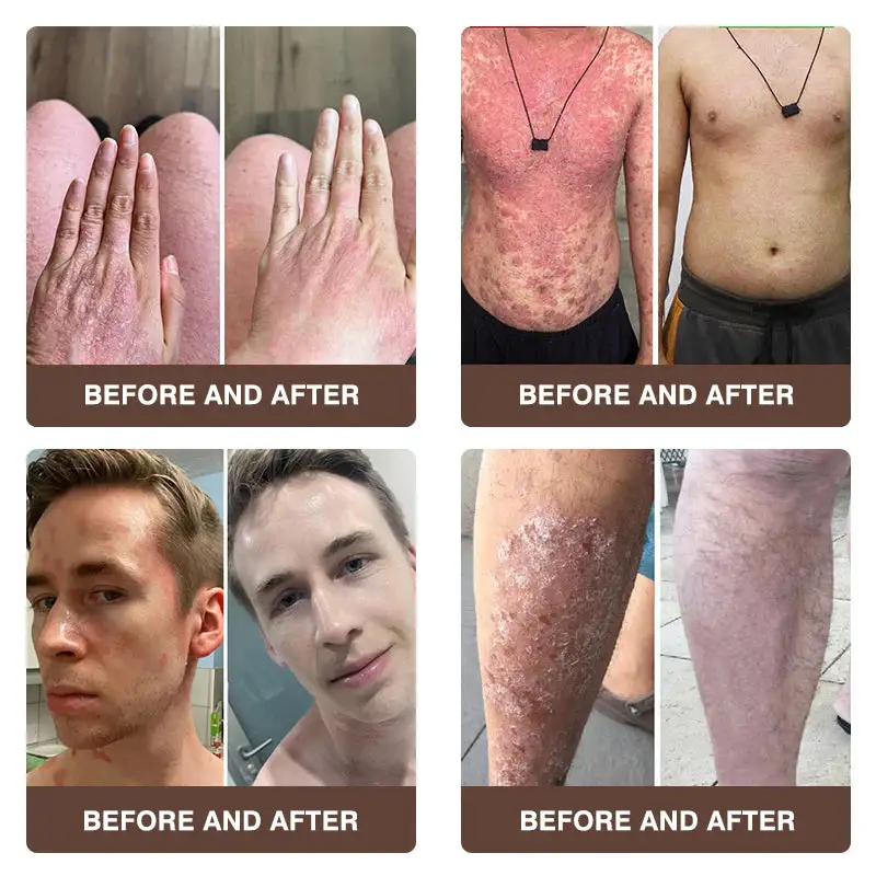 ๐๐ฎ๐ฅ๐ญ๐ข-๐๐ฒ๐ฆ๐ฉ๐ญ๐จ๐ฆ ๐๐ฌ๐จ๐ซ๐ข๐๐ฌ๐ข๐ฌ & ๐๐๐ณ๐๐ฆ๐ ๐๐ซ๐๐๐ญ๐ฆ๐๐ง๐ญ ๐๐ซ๐๐๐ฆ - Image 7