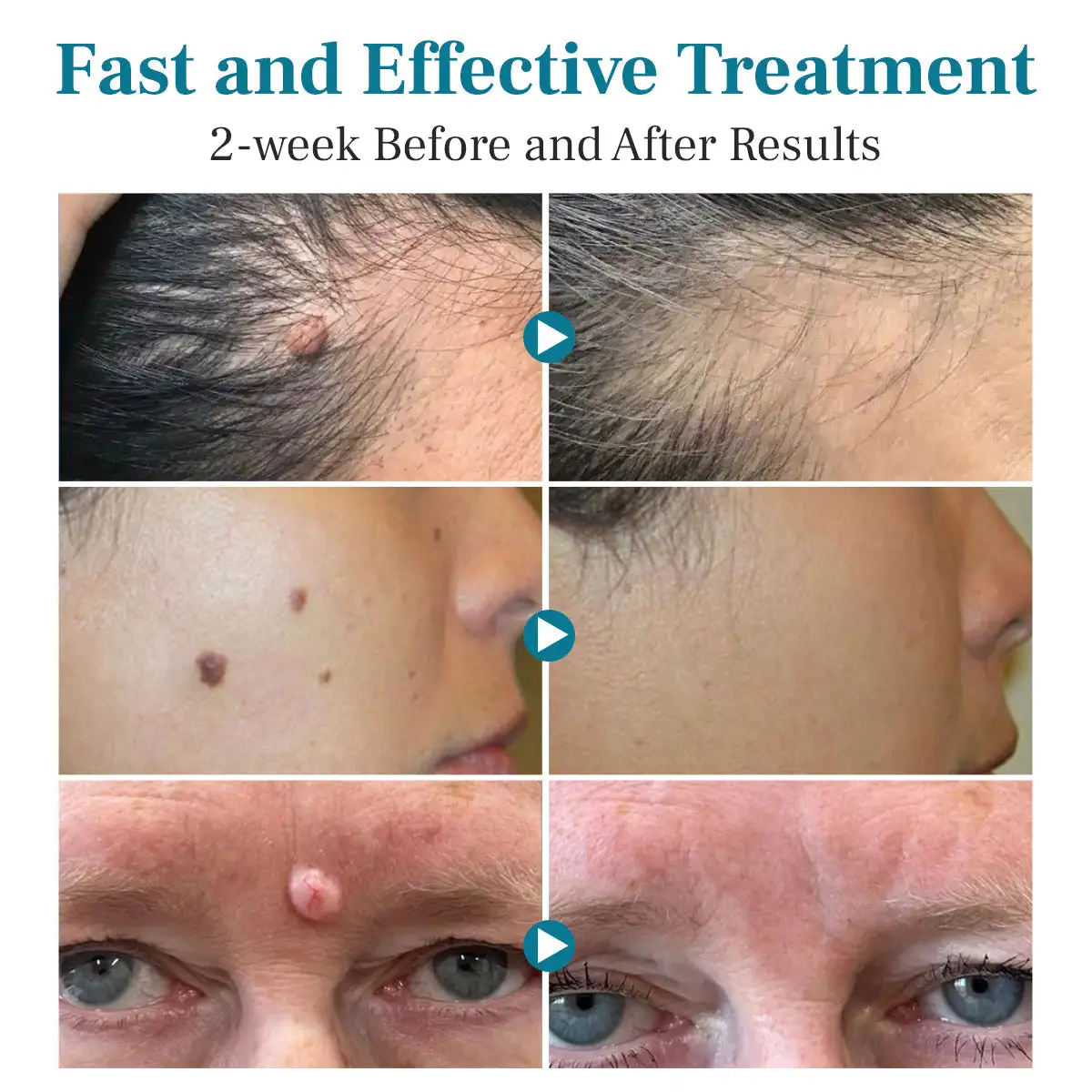 LumeSkin Mole and Wart Removal Laser Pen - Image 2