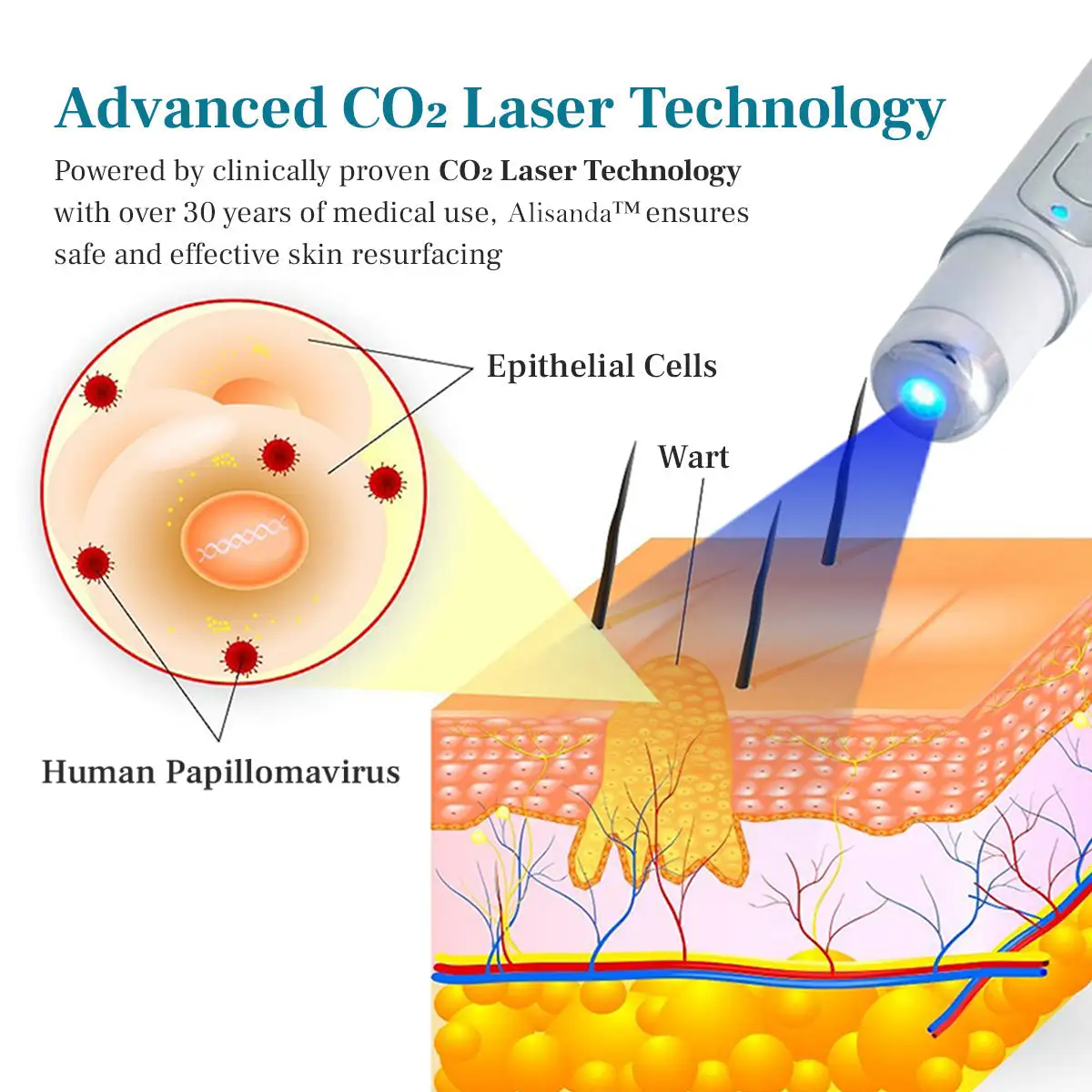 LumeSkin Mole and Wart Removal Laser Pen - Image 7