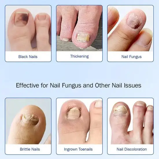 Clinclii Fungus Nail Patches-Suitable for Solving Fungal Nails - Image 5