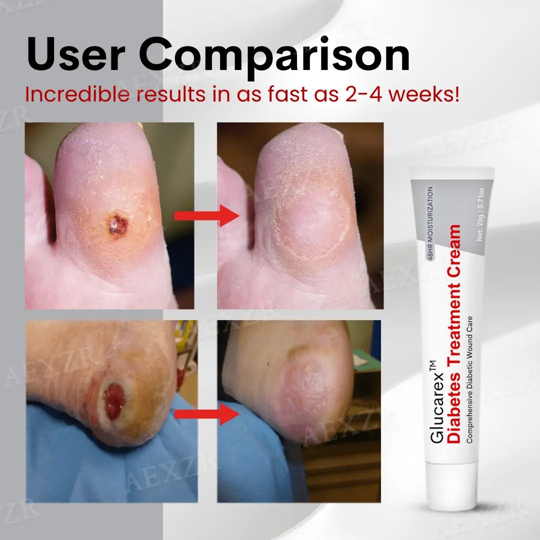 Diabetes Treatment Cream - Image 2