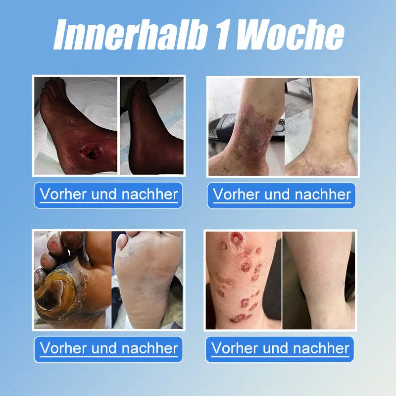 VitaGluco Diabetes Treatment Cream - Image 3