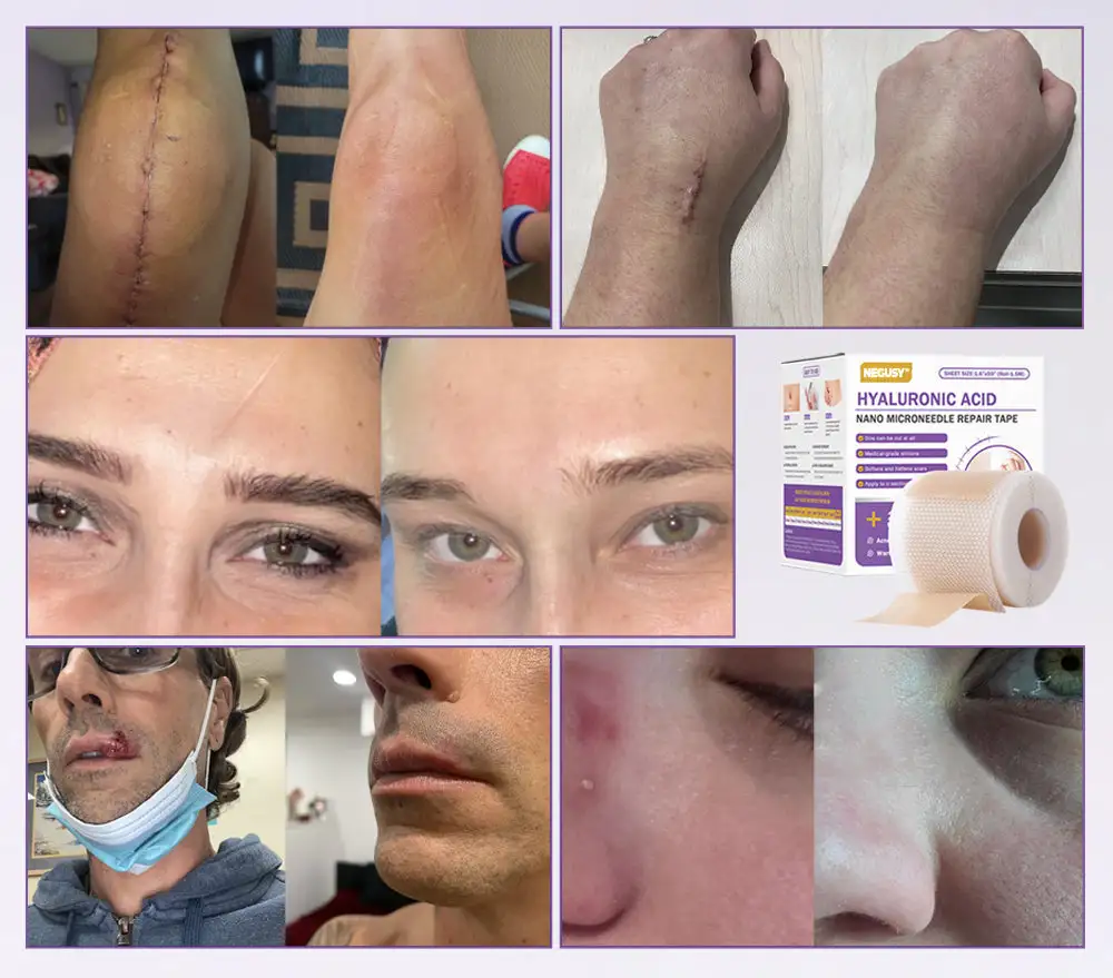 Hyaluronic Acid Nano Microneedle Repair Tape - Image 2
