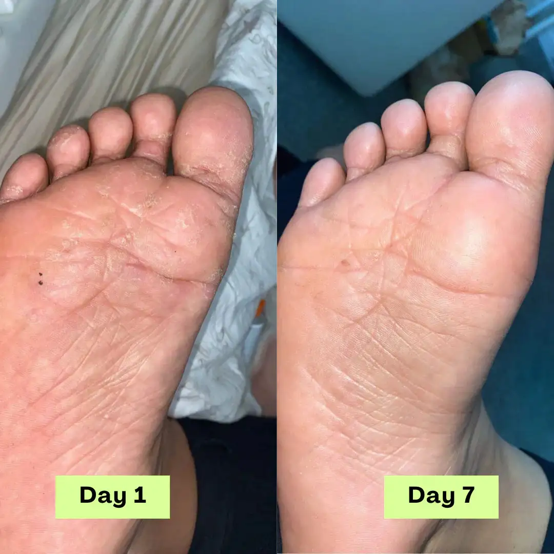 Tea Tree Athlete's Foot Defense Soap - Image 6