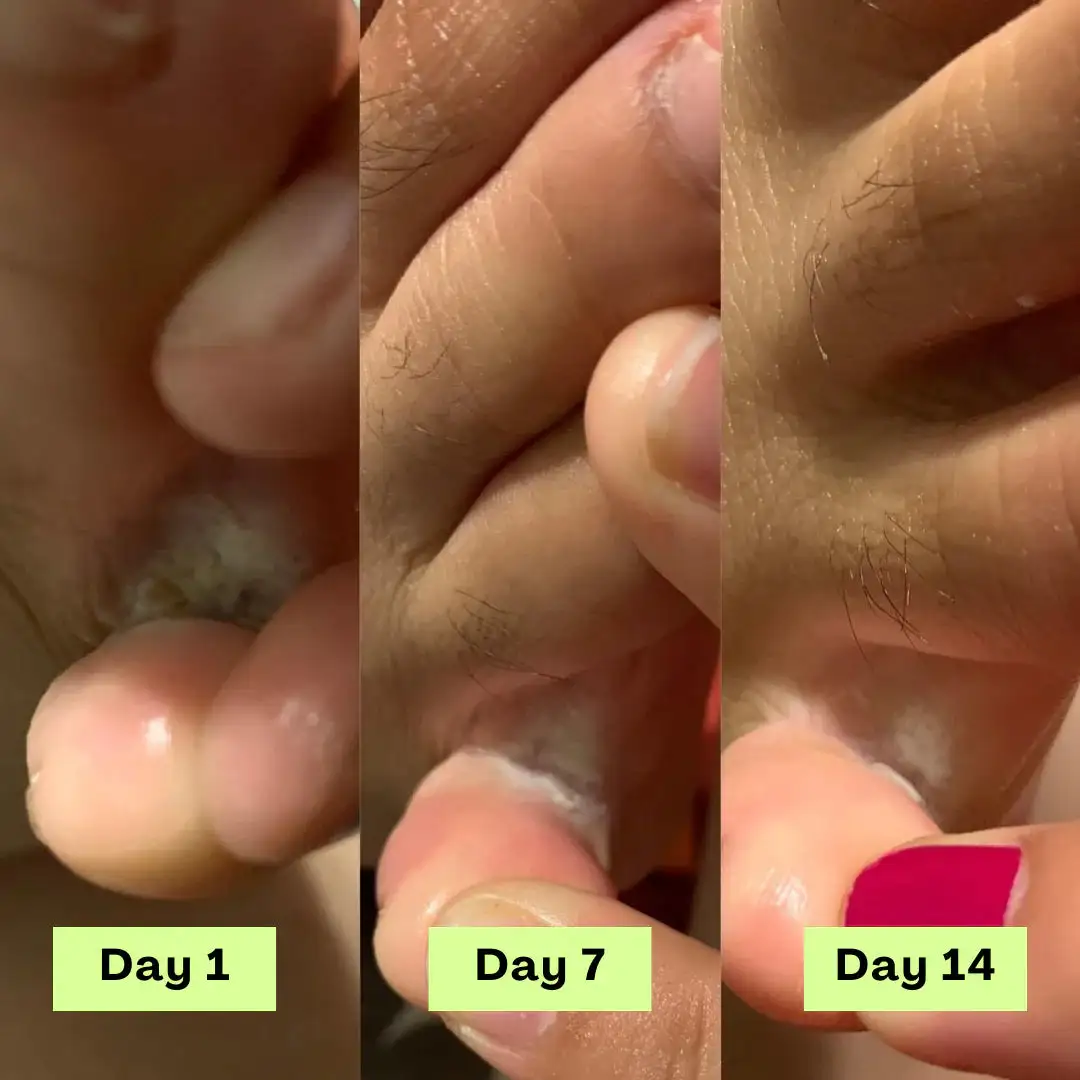 Tea Tree Athlete's Foot Defense Soap - Image 8