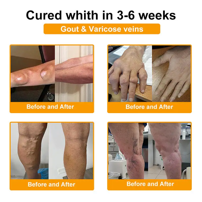 BEE VENOM LITHOSPERMUM Pain-Relief Bone Healing Cream - Image 6