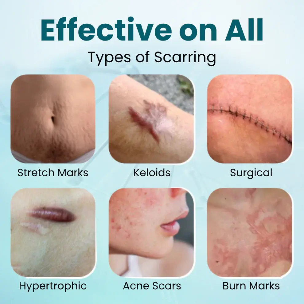 Advanced Scar Gel for Surgical Scars - Image 2