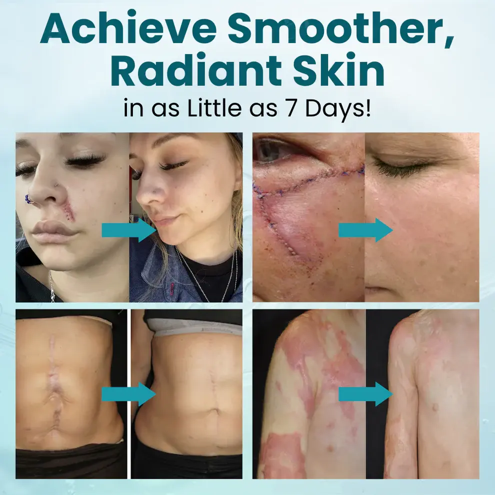 Advanced Scar Gel for Surgical Scars - Image 3