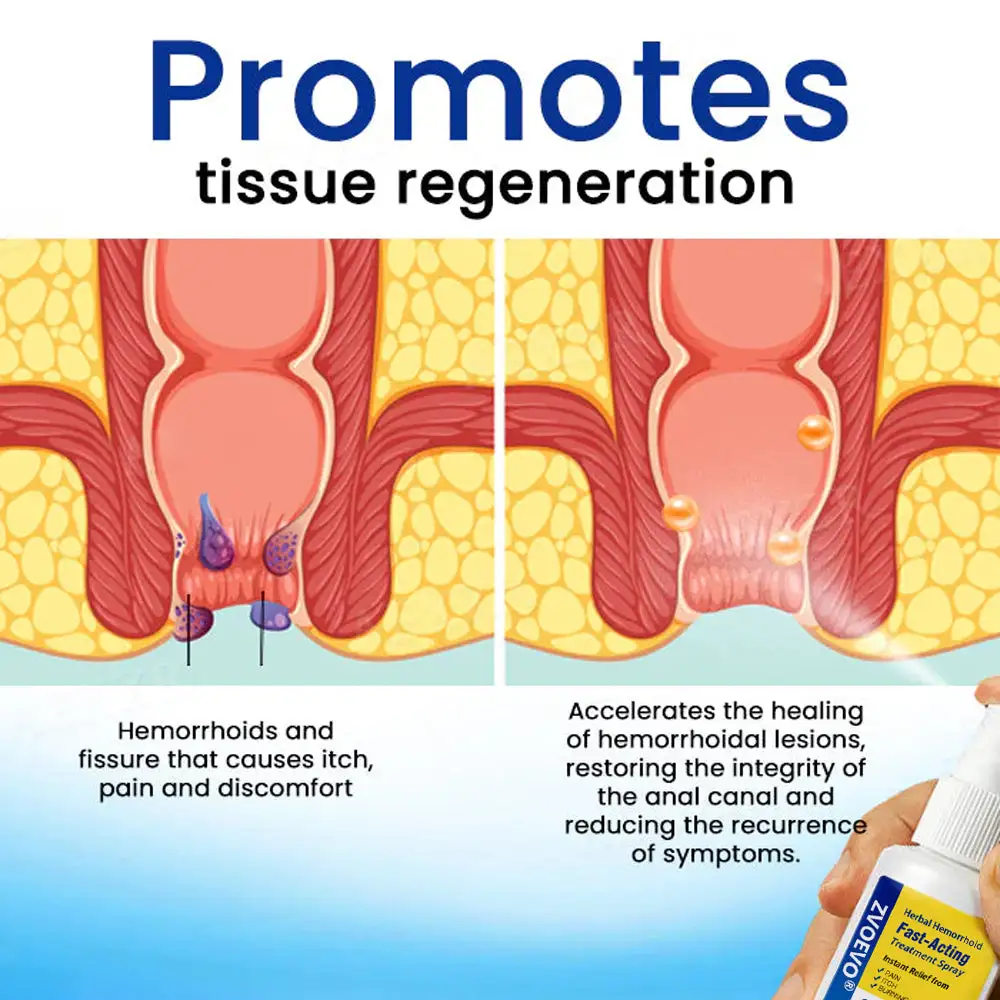 Herbal Hemorrhoids Fast-Acting Treatment Spray - Image 3