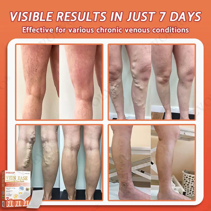 Vein Ease Microneedle Care Patch - Image 4